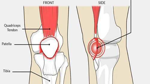 PFPS/PatelloFemoral Pain Syndrome