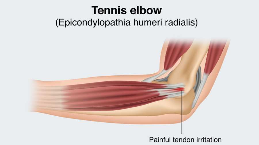 Tennis Elbow / Definition and causes 