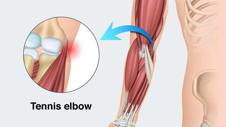 Tennis Elbow / Treatment 