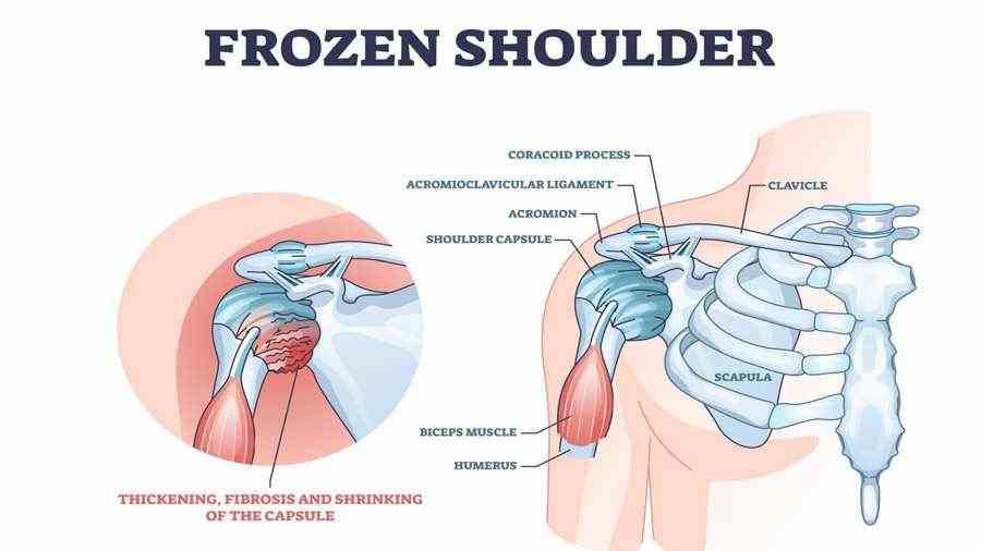 Frozen Shoulder