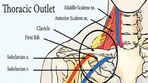 TOS/Thoracic Outlet Syndrome title=